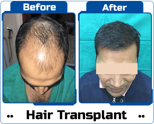 Hair Transplant Case Study-1