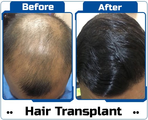 Hair Transplant Case Study-2