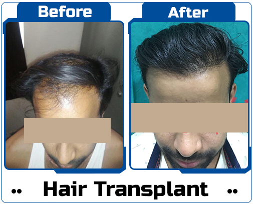 Hair Transplant Case Study-3