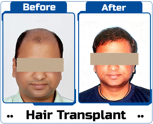 Hair Transplant Case Study-4