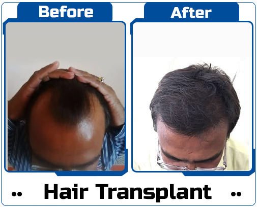 Hair Transplant Case Study-5