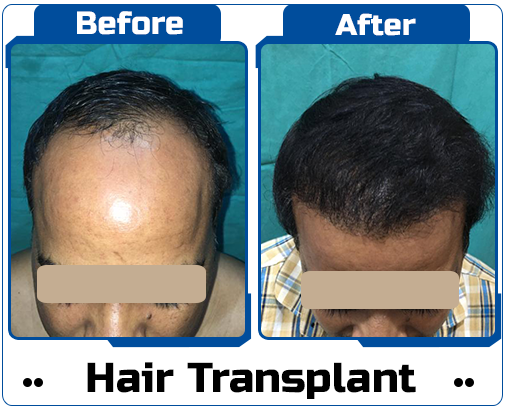 Hair Transplant Case Study-6