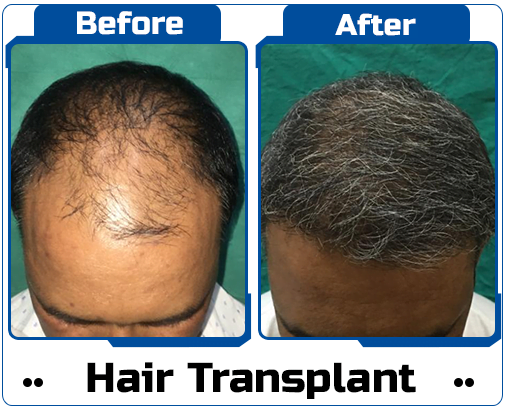 Hair Transplant Case Study-8