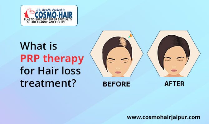 What is PRP therapy for Hair loss treatment?