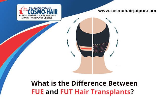 What is the Difference between FUE and FUT Hair Transplants?