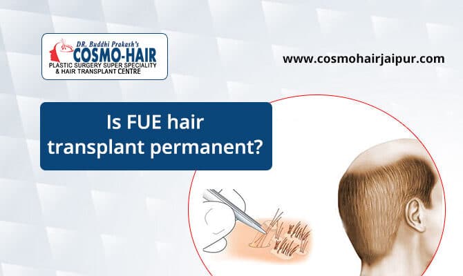 Is FUE Hair Transplant Permanent?