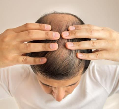 hair transplant cost