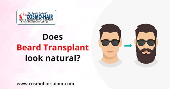 Does beard transplant look natural?