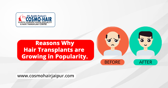 Reasons why hair transplants are growing in popularity?