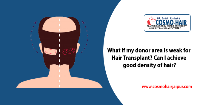 What if my donor area is weak for hair transplant? Can I achieve good density of hair?