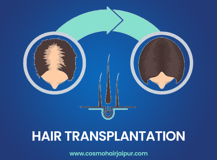 Hair Transplant Cost in Udaipur