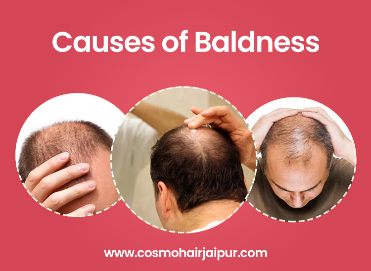 Causes of Baldness