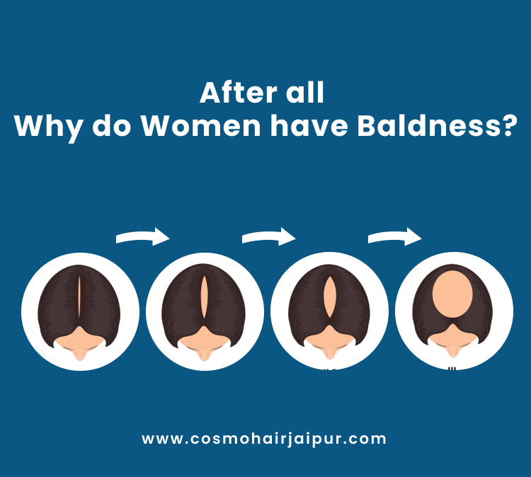 Hair Transplant Women in Jaipur