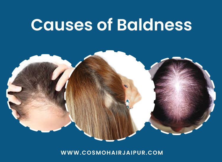 Hair Transplant Women in Jaipur