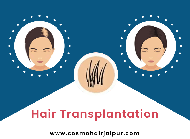 Hair Transplant Women in Jaipur