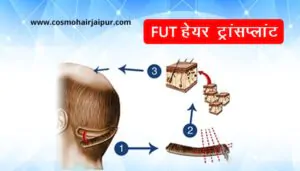 FUT हेयर ट्रांसप्लांट