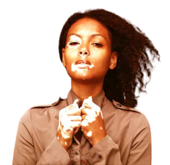 Vitiligo Treatment in Jaipur