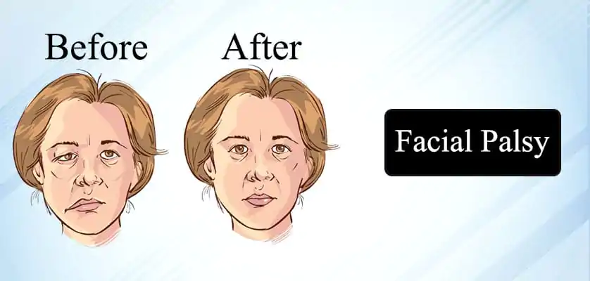 Facial Palsy Treatment in Jaipur