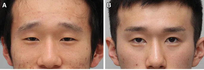 Ptosis Treatment In Jaipur