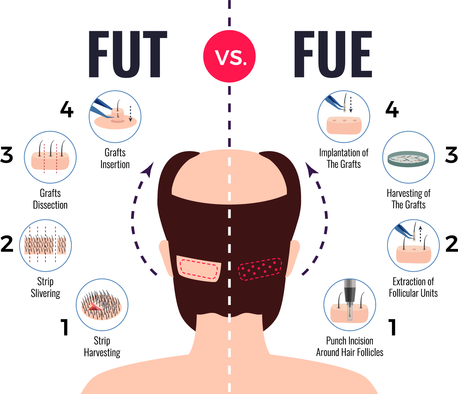 Hair Transplant Cost In Ajmer