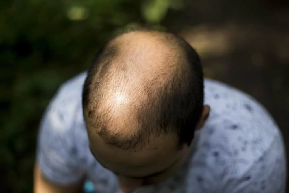Male Pattern Baldness Hindi